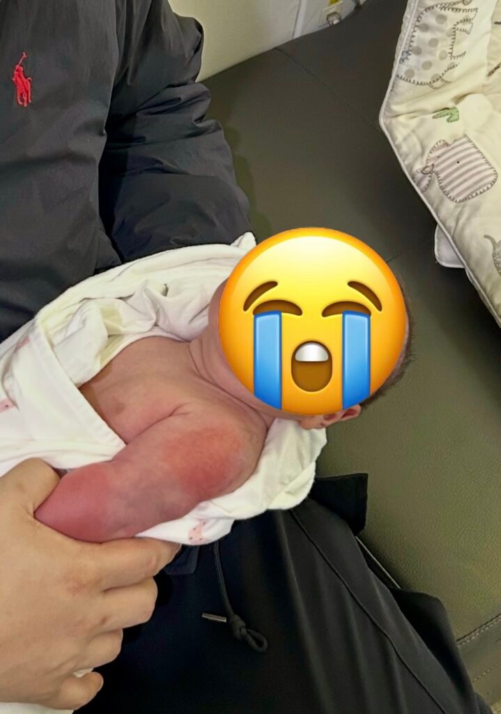 신생아 BCG 경피용 예방접종 후 도장형 접종 부위 사진